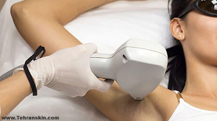 چرا موهای من بعد از لیزر موهای زائد هنوز نریخته؟ چقدر طول می کشد تا موها بریزند؟