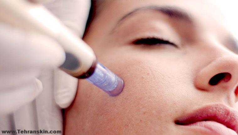 هزینه میکرونیدلینگ چقدر است؟