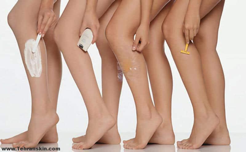 از بین بردن موهای پا