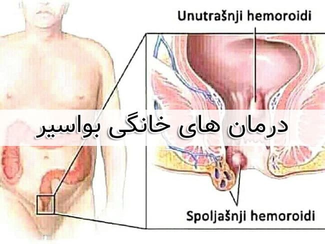 روغن نارگیل برای درمان هموروئید