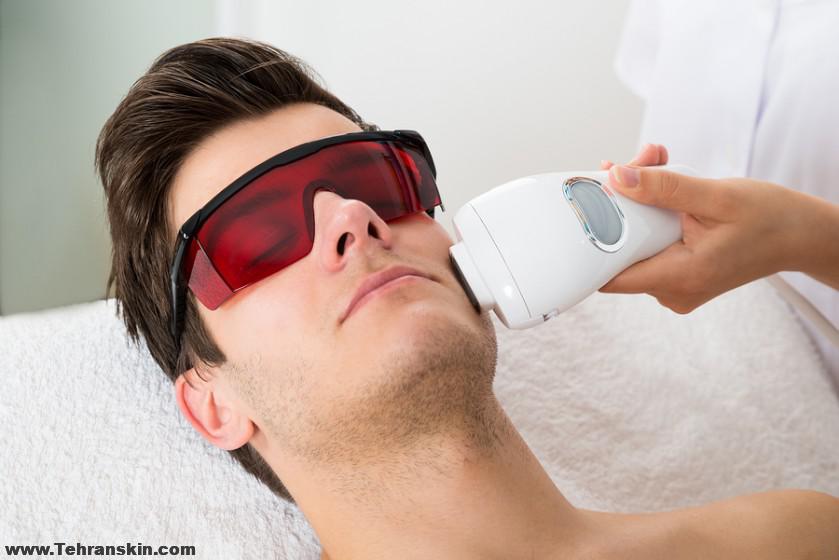 لیزر موهای زائد آقایان