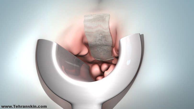 هزینه عمل جراحی هموروئید چقدر است؟ تشخیص و درمان | بهترین جراح همورئید