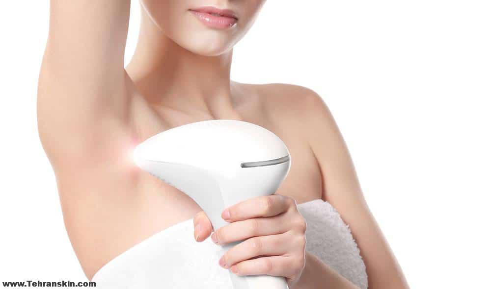 لیزر موهای زائد خانگی