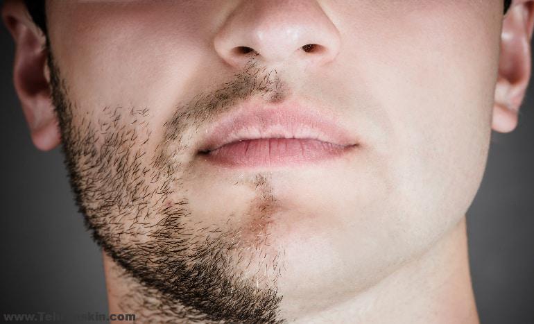 از بین بردن موهای زائد بدن مردان