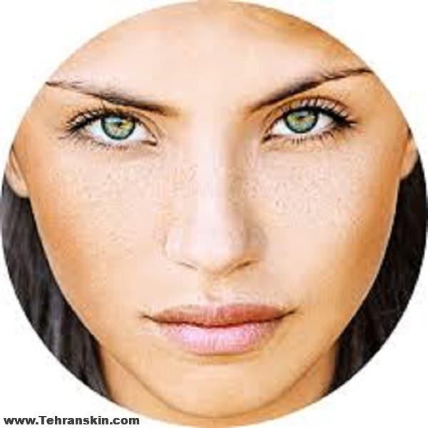 تخفیف عالی لیفت پلک بدون جراحی