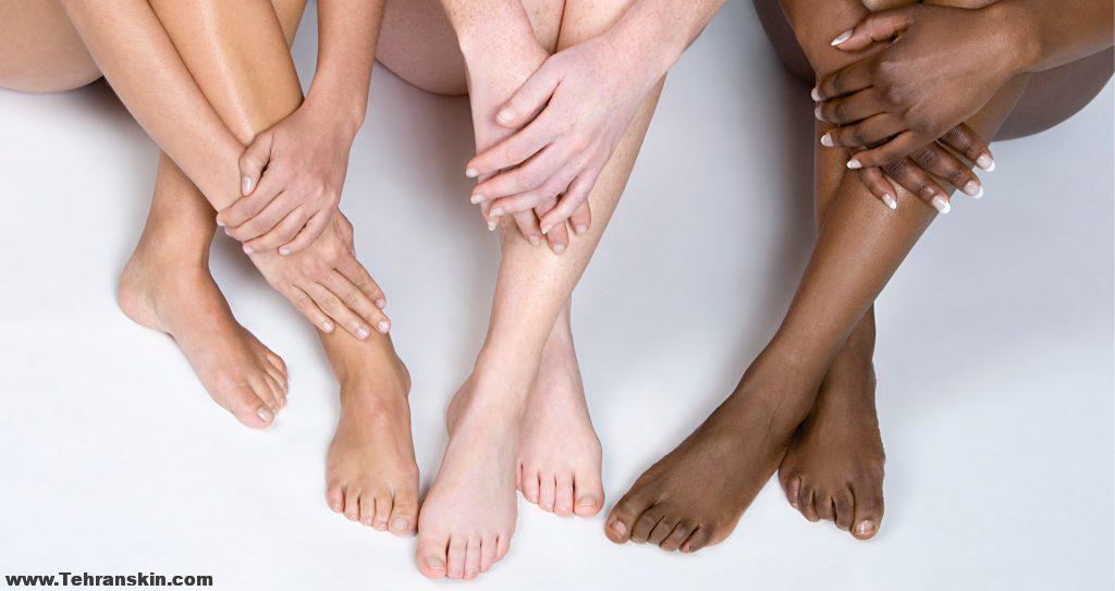 لیزر موهای زائد