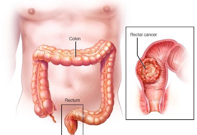 تفاوت سرطان رکتوم با هموروئید چیست ؟ آیا بواسیر باعث سرطان  می شود؟ 