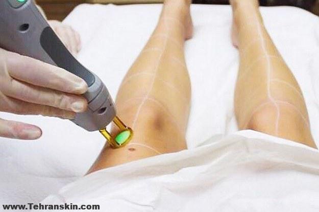 هزینه لیزر موهای زائد