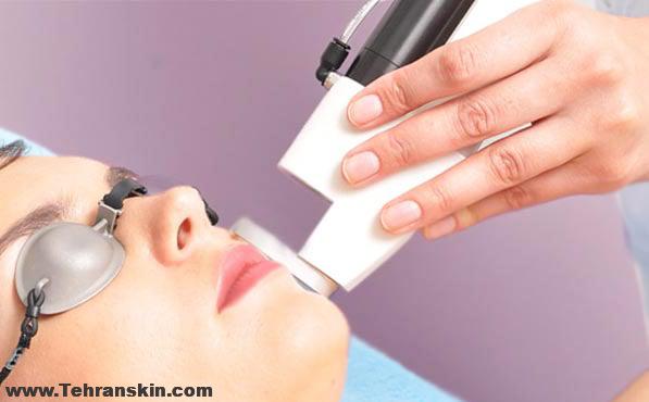 لیزر موهای زائد چگونه انجام می شود