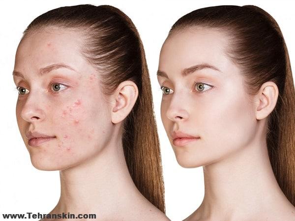 درمان جوش صورت با لیزر: تداخل با لیزر موهای زائد اسکلپیون مدیواستار مرکز برکه؟