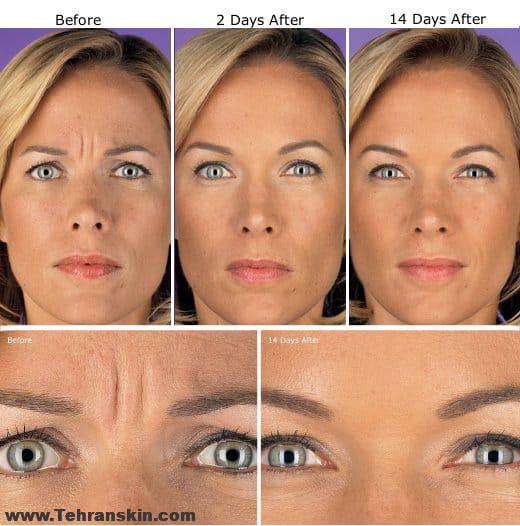 بوتاکس درمان جادویی برای زیبایی و سردرد میگرنی | مرکز لیزر و زیبایی برکه