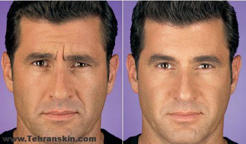 بوتاکس یک سم که شما را زیبا تر و جوان تر می کند | تزریق بوتاکس در مرکز لیزر و زیبایی برکه