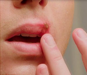 بیماری های ناحیه تناسلی زنان | لیزر موهای زائد ناحیه تناسلی | مرکز لیزر برکه