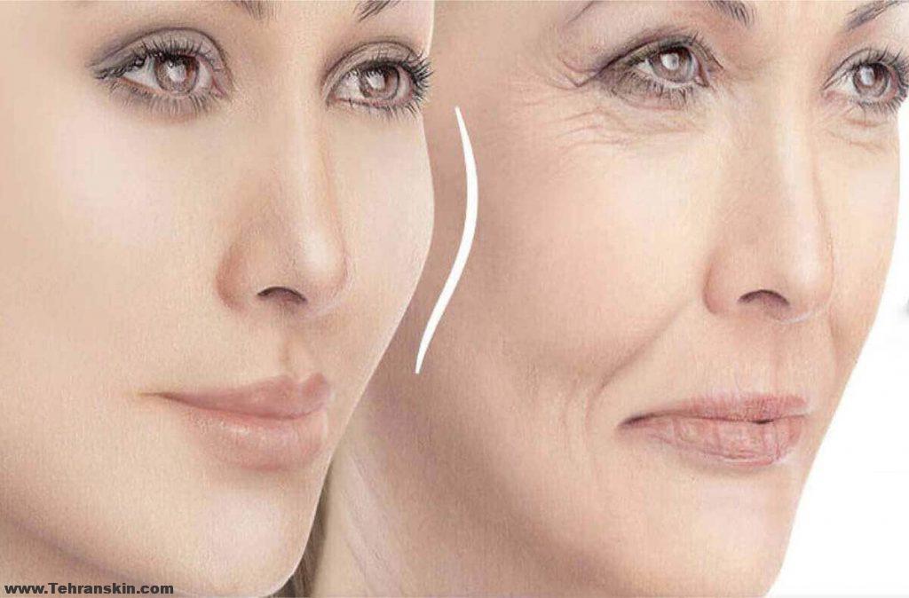 بوتاکس برای چروک های دور چشم | درمان چروک های دور چشم | مرکز تزریق بوتاکس