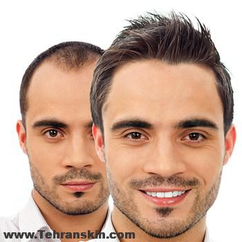 مواظب عوارض کاشت مو باشید بهترین روش برای درمان ریزش مو چیست