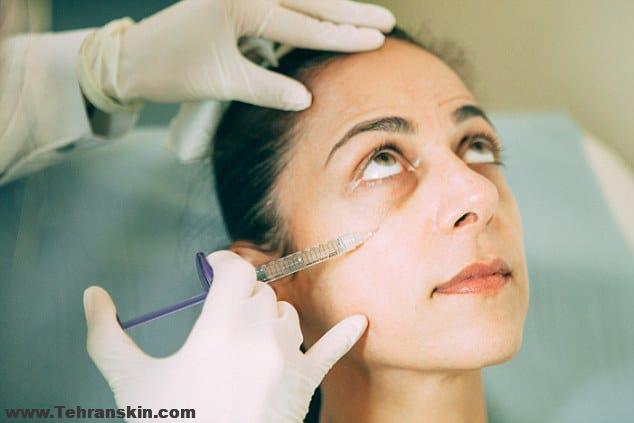 تزریق فیلر زیر چشم