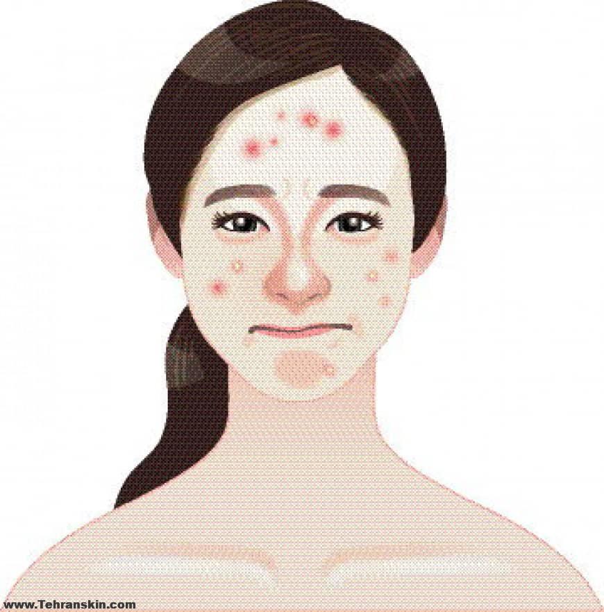 آیا لیزر موهای زائد باعث جوش میشود