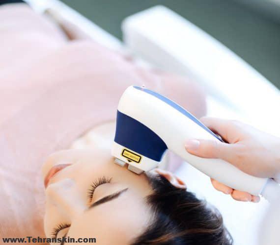 روش کار لیزر موهای زائد