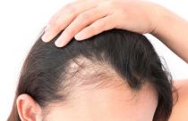 درمان کچلی ارثی در زنان | نشانه های ریزش موی ارثی | کاشت مو