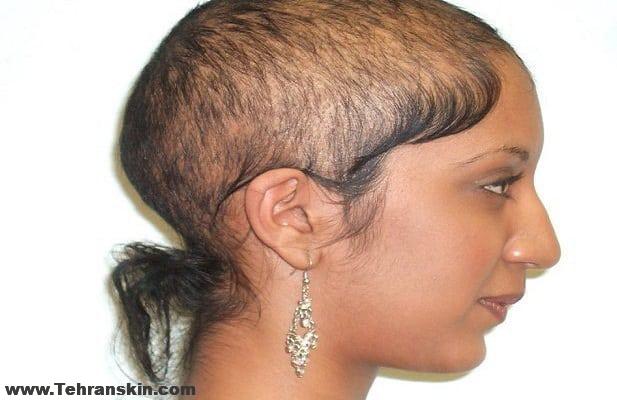 مهم ترین علت ریزش مو | جلوگیری از ریزش مو ارثی | لیزر درمانی برای ریزش مو