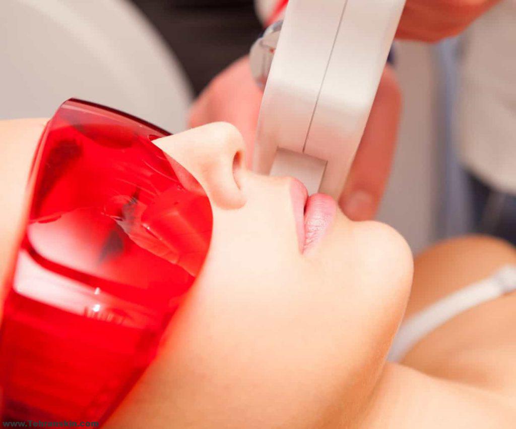 لیزر دائمی موهای زائد