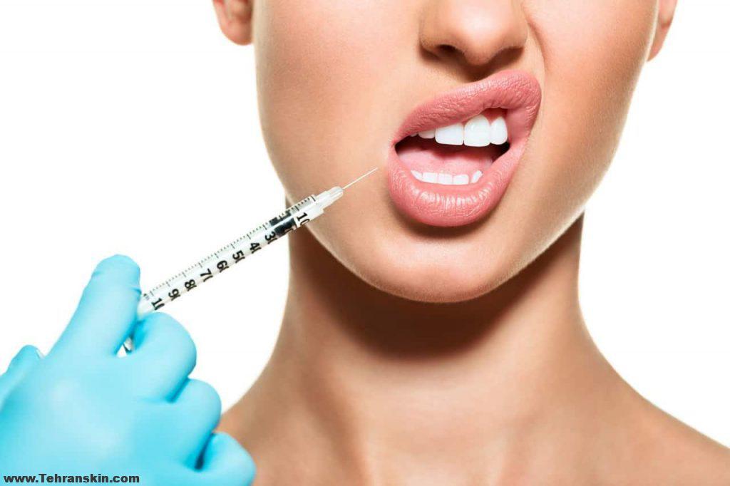 تزریق ژل لب طبیعی
