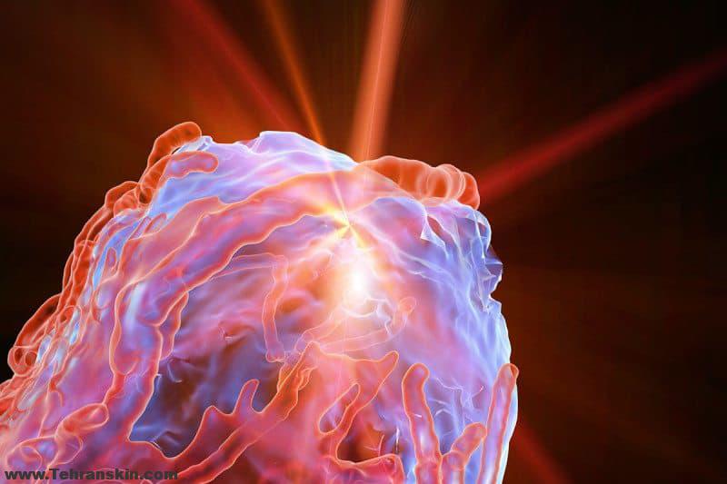 لیزر و سرطان