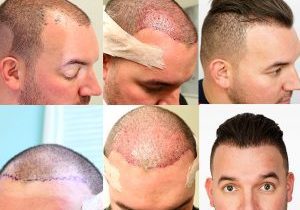 درمان های خانگی طبیعی برای پیشگیری از ریزش مو | کاشت مو درمان قطعی ریزش مو
