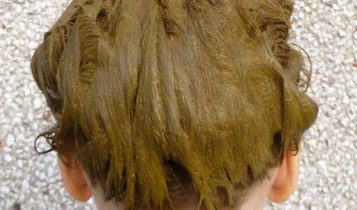 درمان های خانگی طبیعی برای پیشگیری از ریزش مو | کاشت مو درمان قطعی ریزش مو