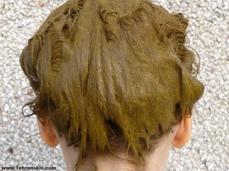 درمان های خانگی طبیعی برای پیشگیری از ریزش مو | کاشت مو درمان قطعی ریزش مو