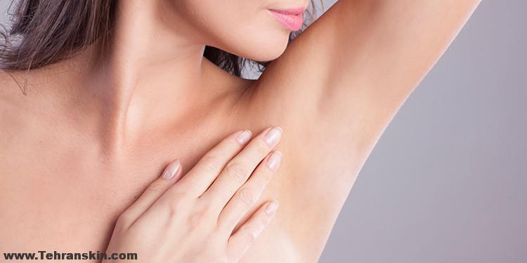 لیزر برای موهای زائد