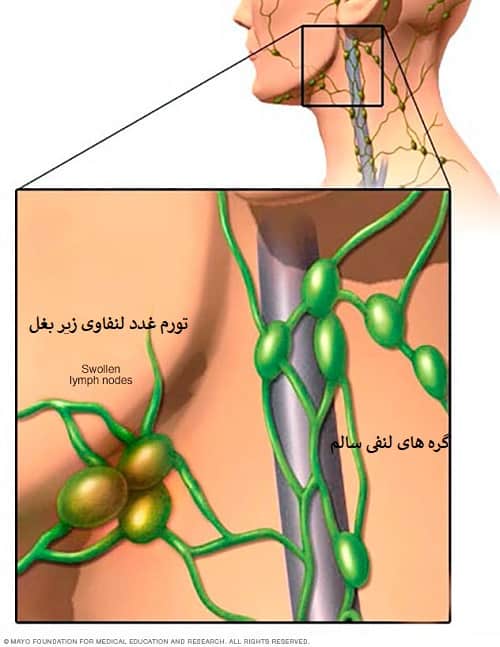 لیزر و تورم غدد لنفاوی