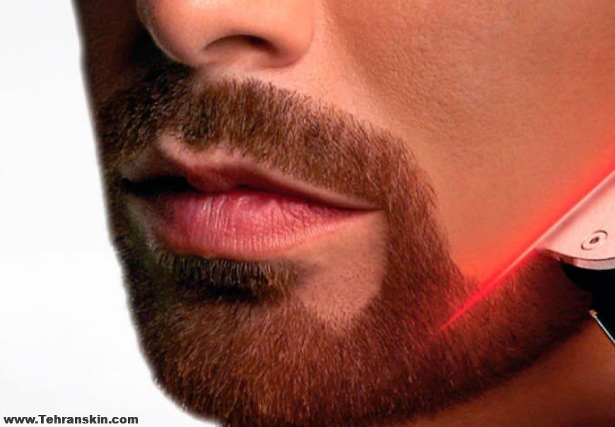 لیزر خط ریش