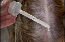 بهترین داروی ریزش مو | ماینوکسیدیل = درمان ریزش مو | بهترین روش کاشت مو