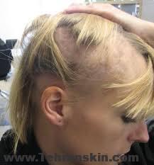 دلایل ریزش مو در زنان چیست؟ دلایل شوره سر و ریزش مو در مردان | کاشت مو