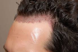 مهم ترین علت ریزش مو | جلوگیری از ریزش مو ارثی | لیزر درمانی برای ریزش مو 
