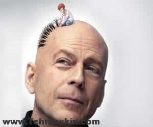 بهترین مزایای جراحی پیوند مو | مزایا و معایب پیوند مو | بهترین مرکز پیوند مو