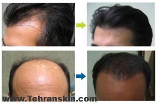 بهترین داروی ریزش مو | ماینوکسیدیل = درمان ریزش مو | بهترین روش کاشت مو
