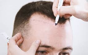 مرکز معتبر کاشت مو | درمان ریزش مو با حنا | آب پیاز برای درمان ریزش مو