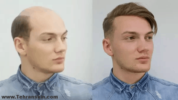 بهترین مزایای جراحی پیوند مو | مزایا و معایب پیوند مو | بهترین مرکز پیوند مو