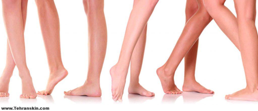 لیزر موی زائد