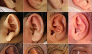 سیستم جدید اصلاح گوش های غیر طبیعی و بد شکل نوزاد سیستم جدید اصلاح گوش های غیر طبیعی و بد شکل نوزاد