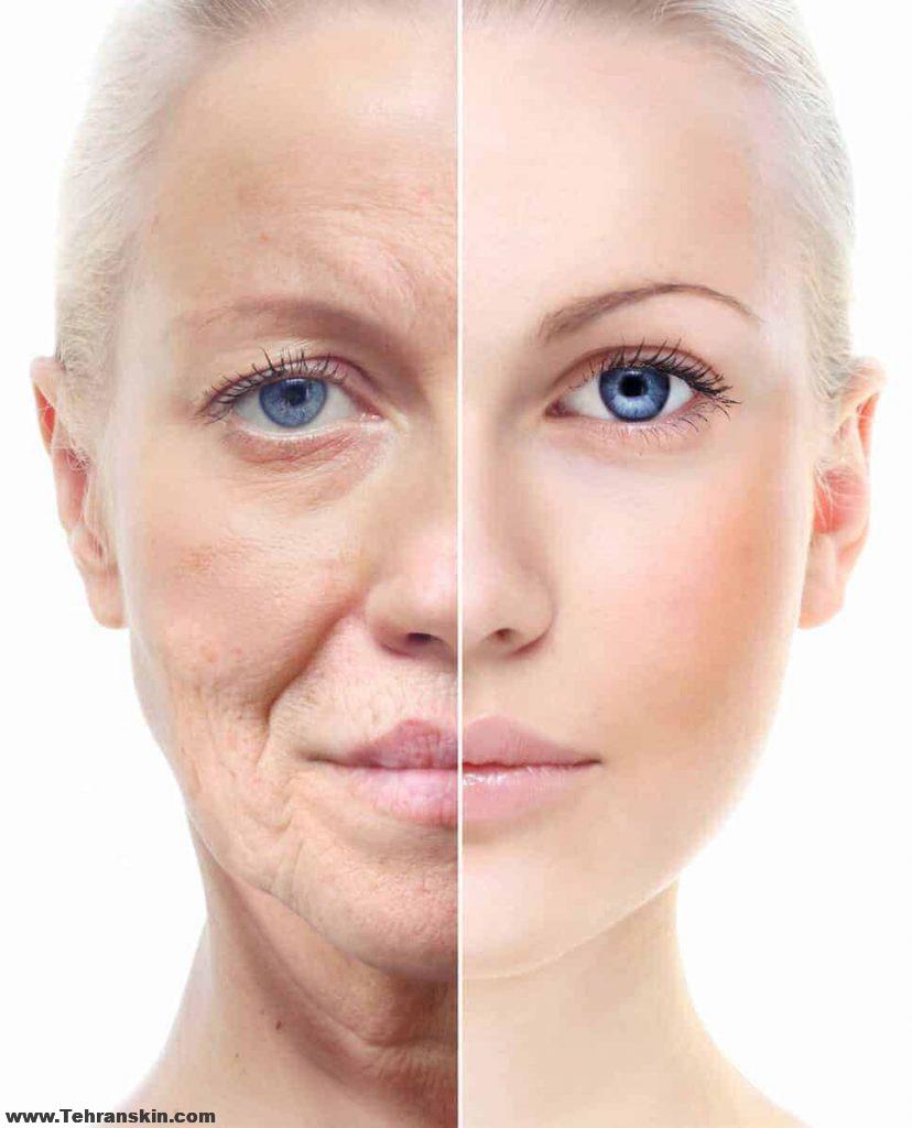 مزایای تزریق چربی