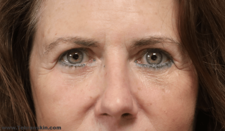 تزریق چربی زیر چشم