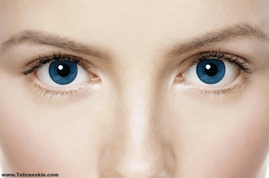 لیزر موهای زائد برای پوست روشن