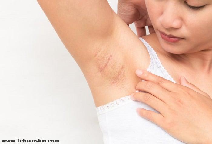 عوارض لیزر زیر بغل و لیزر پوست: تغییر رنگ پوست: لیزر در یک آرایشگاه