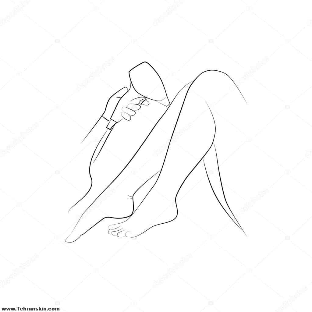 نکات قبل از لیزر موهای زائد