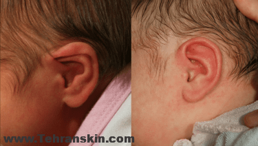 اصلاح گوش های غیر طبیعی و بد شکل نوزادان بدون جراحی | جراحی زیبایی گوش
