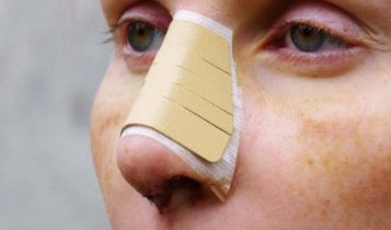 چطور بعد از عمل دماغ زودتر بهبود پیدا کنیم؟