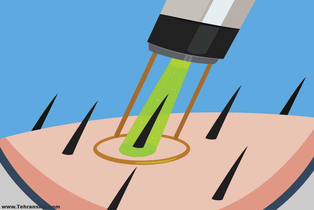 لیزر کردن موهای زائد بیکینی